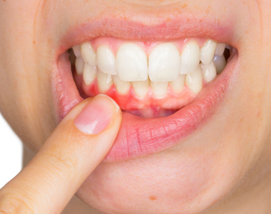 What Causes Receding Gums?