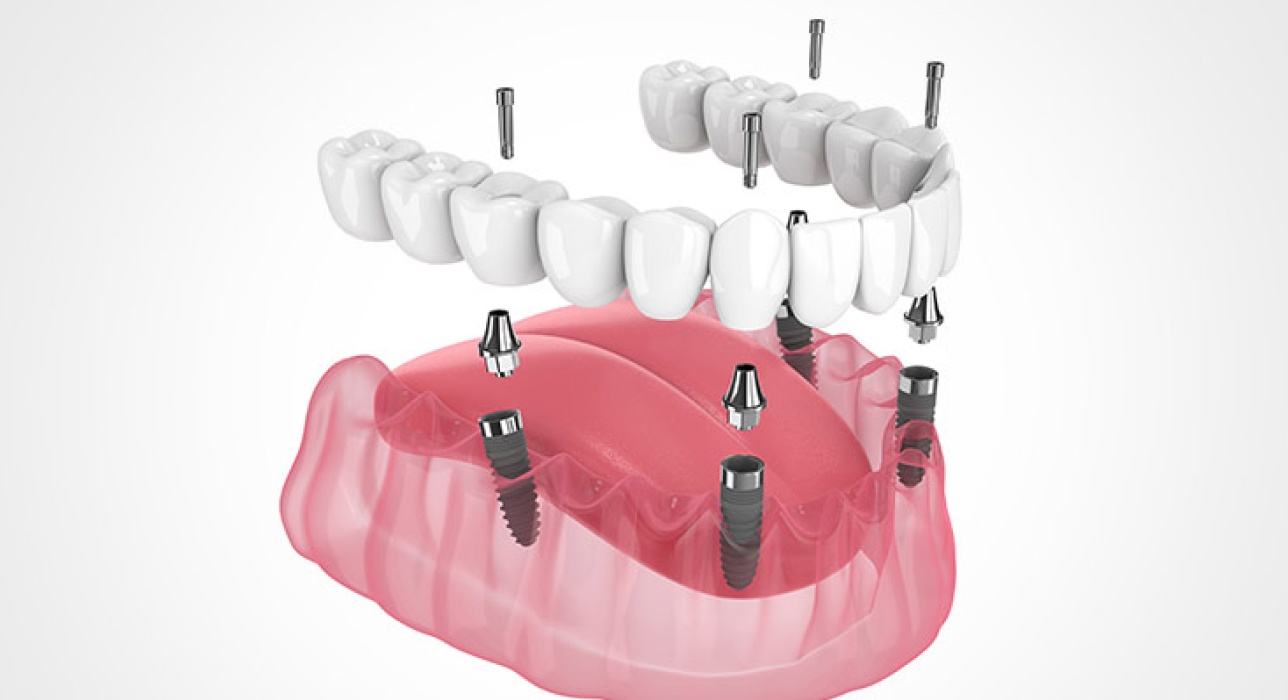 Implant-Supported Dentures West Chester, Ohio
